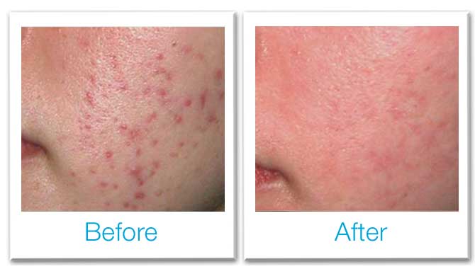 Acne Pimples Treatment and Acne Scar Treatment In Pune