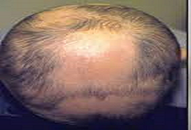 Alopecia Area