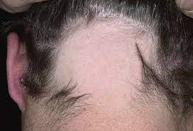 Alopecia Area