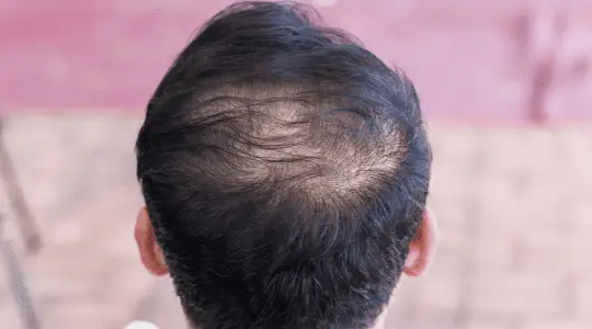 Hair Treatment in Pune