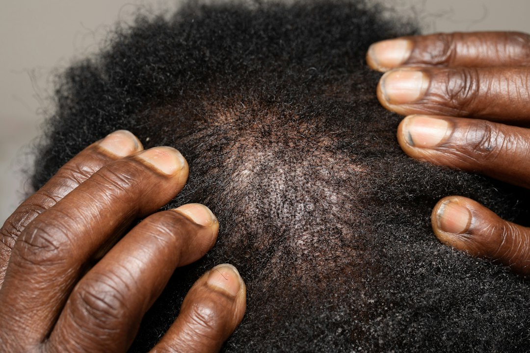 Close-up top view of a scalp showing thinning hair, illustrating hair loss before a hair transplant